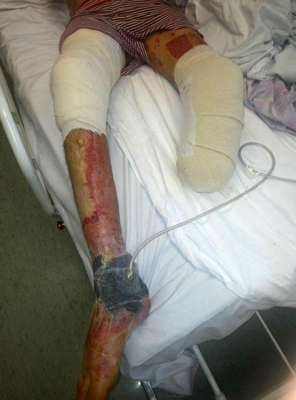 Man lost leg after “pals set him on fire as he slept drunk on bathroom floor”