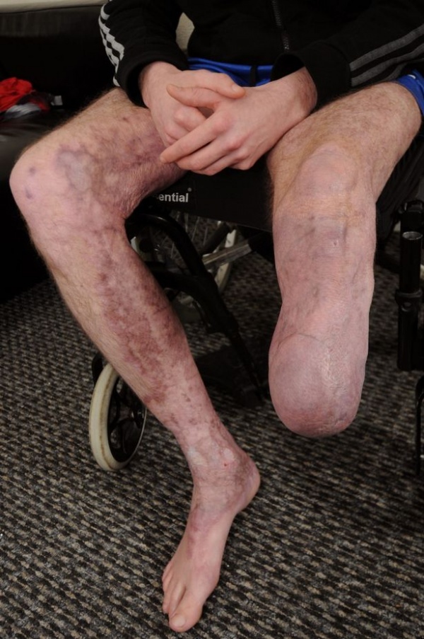 Man lost leg after “pals set him on fire as he slept drunk on bathroom floor” Man lost leg after “pals set him on fire as he slept drunk on bathroom floor”
