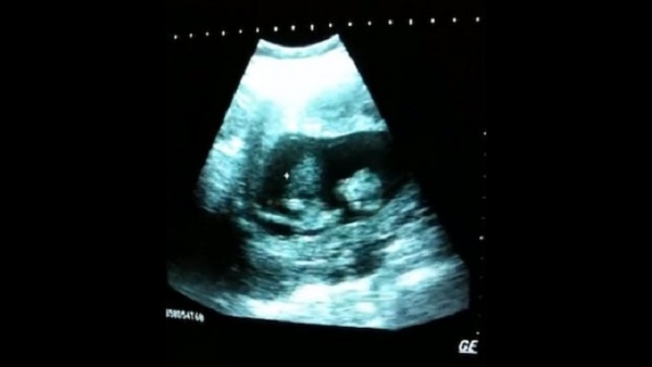 Unborn Baby 